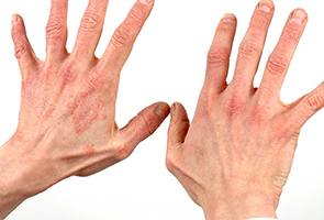 Dermatitis Showing Reddening of Skin - Photo credits – Contains public sector information published by the Health and Safety Executive and licensed under the Open Government Licence v1.0.